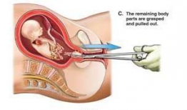 流产视频,真实视频背后的真相与警示